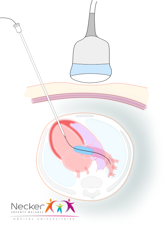 dilatation
