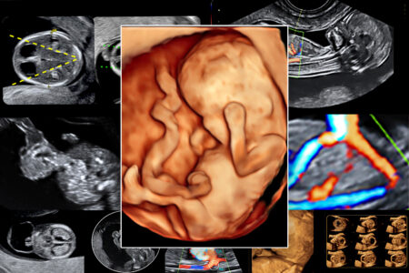 L’écho-morphogramme normal & pathologique au premier trimestre de la grossesse
